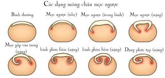cắt móng chân đúng cách